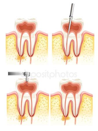 Root Canal Treatment Vector Images Depositphotos