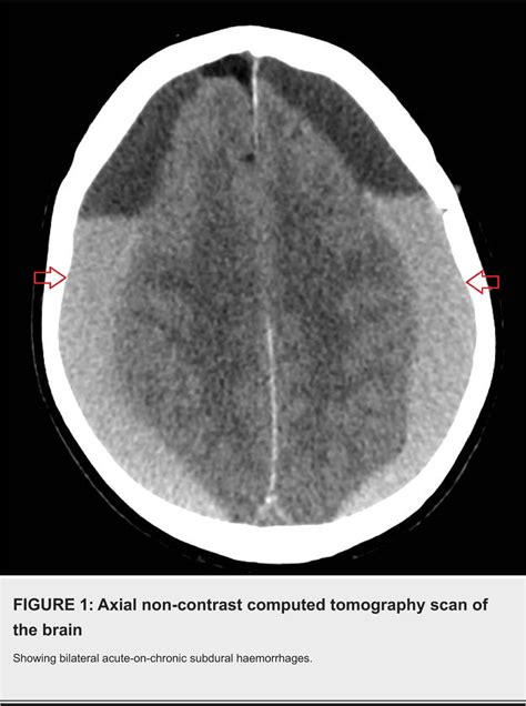 Figure 1 From Tension Pneumocephalus Following Bilateral Craniotomies