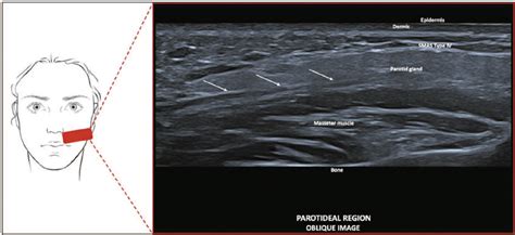 Scielo Brazil U Smas Ultrasound Findings Of The Superficial