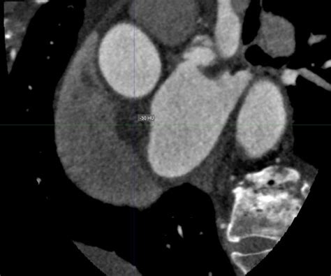 Lipomatous Hypertrophy Of The Interatrial Septum Radiology Reference Article