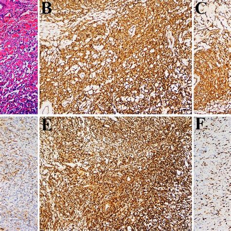 Histological And Immunohistochemical Features A Hematoxylin And Eosin