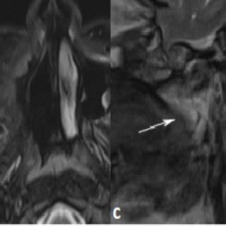 Post Op MRI S Showing A Axial T1 W Image Showing The Surgical