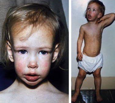 Soto Syndrome - MEDizzy