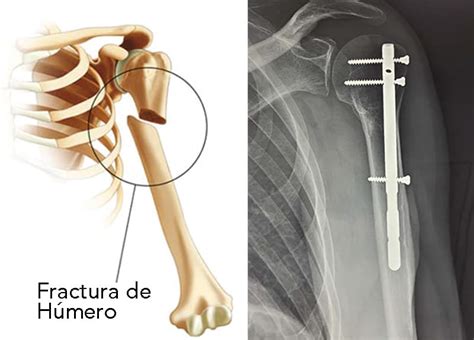 Signos De Fractura De Hueso