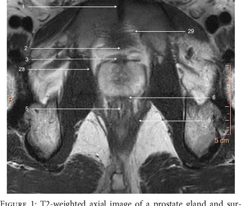 Figure 8 From Normal 3t Mr Anatomy Of The Prostate Gland And Surrounding Structures Semantic