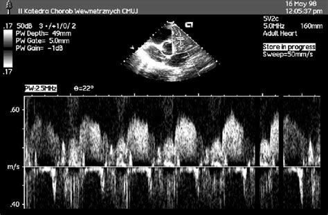 Transthoracic Doppler Echocardiography Noninvasive Diagnostic Window