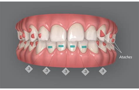 Qué son los ataches de Invisalign Clínica Maydental