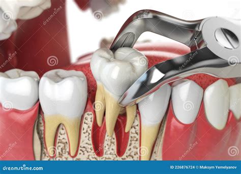 Tooth Extraction By Dental Forceps On Model Of Human Jaw Royalty Free