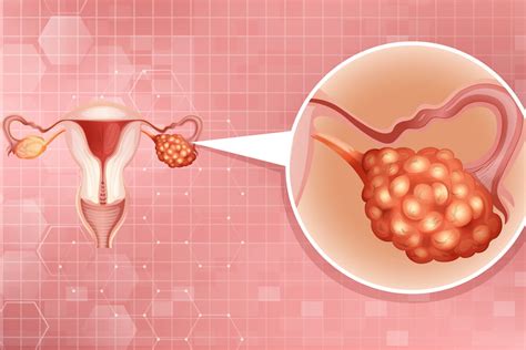 Cancro Ovarico La Scoperta Chiave Che Aiuter A Trovare Nuovi Farmaci