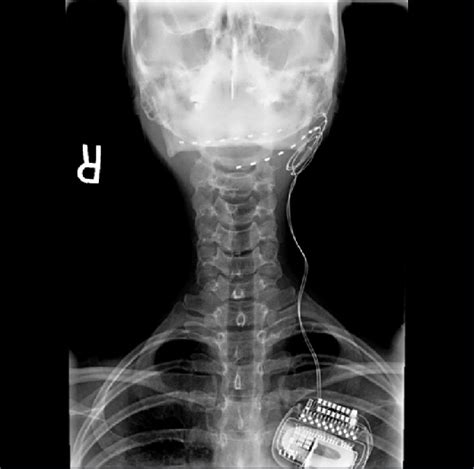 Occipital Nerve Mri – NBKomputer