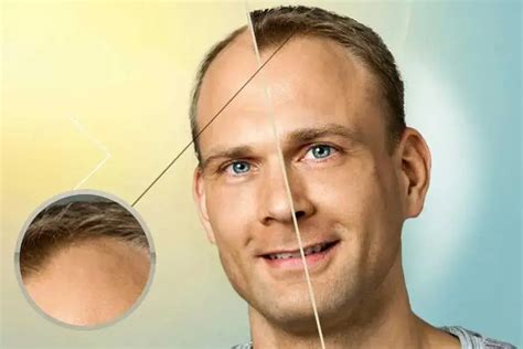 Is Fue Or Dhi The Best Method Of Hair Transplant Global Medical Care