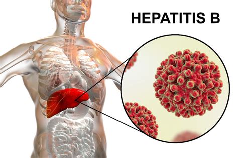 Lhépatite B Causes symptômes diagnostic traitements et prévention