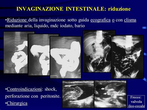 LIMAGING NELLE OCCLUSIONI INTESTINALI DEL NEONATO E DEL LATTANTE Ppt