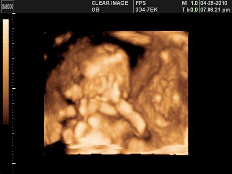 amisbide: 3d ultrasound 20 weeks boy