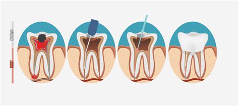 Best Endodontic Treatment In Hyderabad Alux Dental