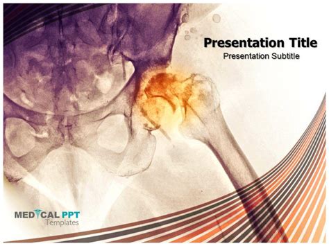 Femur Fractures Medical Ppt Templatesaspxfemur Fractures