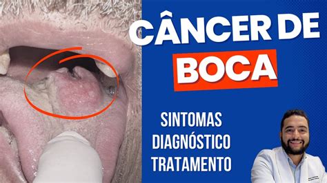 C Ncer De Boca Sintomas Diagn Stico E Tratamento Youtube