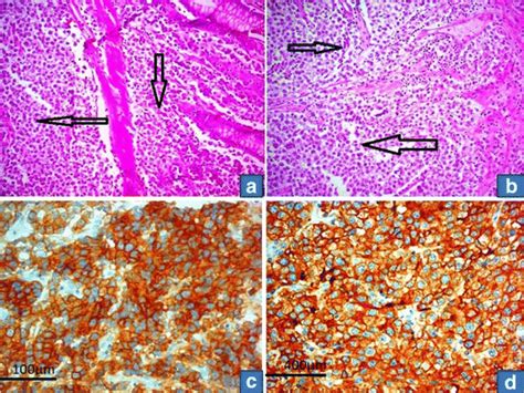 A Tumor Cells Diffusely Infiltrating Colon Wall Arrows Sparing Most