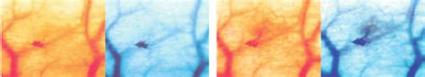 Examples of changes involving blood vessels in the Arthus reaction ...