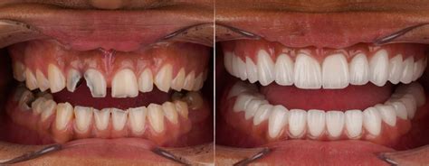 How To Fix A Chipped Front Tooth