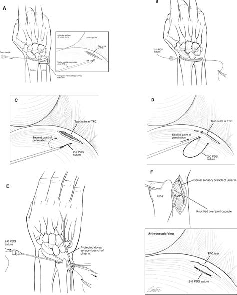 Figure 1 From Arthroscopic Treatment Of Triangular Fibrocartilage Wrist