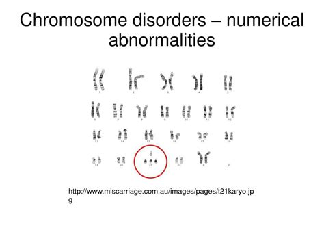 Ppt Chromosome Disorders Numerical Abnormalities Powerpoint