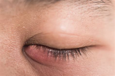 Clogged Tear Ducts Nashua Tear Ducts Manchester Medical Eye Center