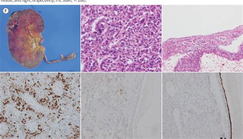 [pdf] Renal Epithelioid Angiomyolipoma With Epithelial Cysts Mimicking