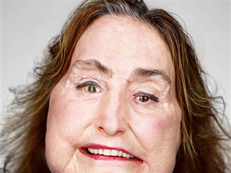 Two Photographers Capture a Face Transplant Surgery