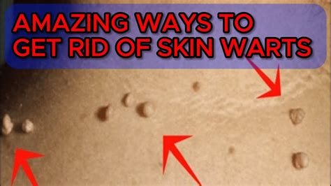 Amazing Ways To Get Rid Of Skin Warts Skin Wart Removal Tips Skin