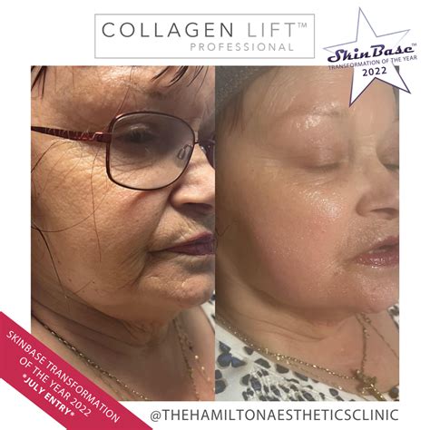 Skinbase Collagen Lift Facial Results