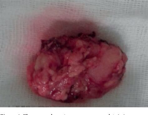 Figure 2 From Castlemans Disease A Rare Retroperitoneal Mass In The