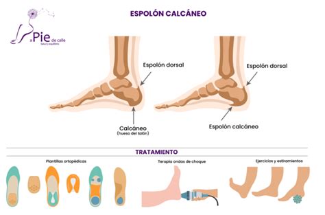 Espol N Calc Neo Prevenci N Y Tratamiento