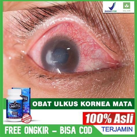 Jual Obat Ulkus Kornea Infeksi Kornea Mata Luka Pada Kornea Mata