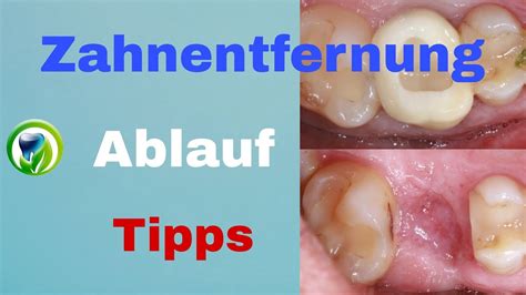 Zahnentfernung Zahnextraktion Zahn muss raus Schritt für Schritt