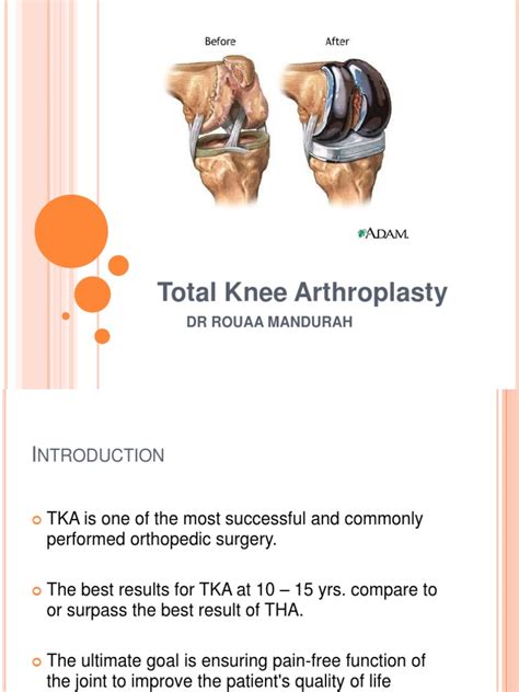 Total Knee Arthroplasty | Knee | Joints