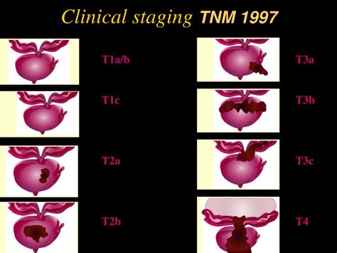 PPT - Prostate Cancer PowerPoint Presentation, free download - ID:3016914