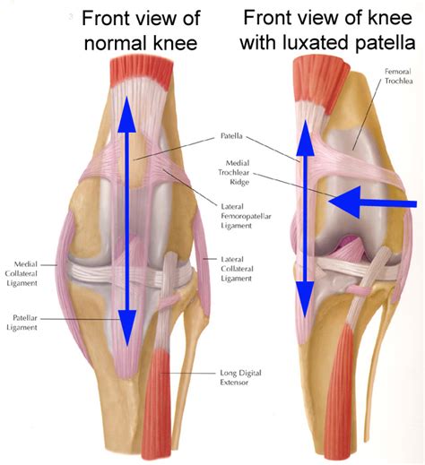 Knee Dislocation Reduction