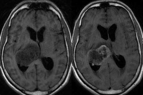 Glioma: Glioma Mri