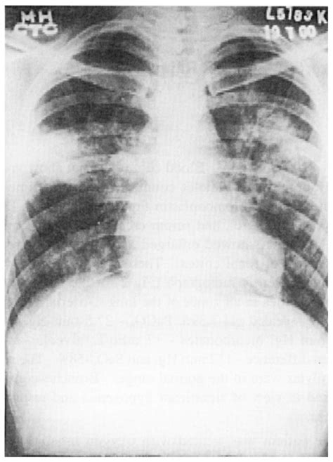 Chest Radiograph Cpa View Showing Nodular Opacities In Left Upper Zone