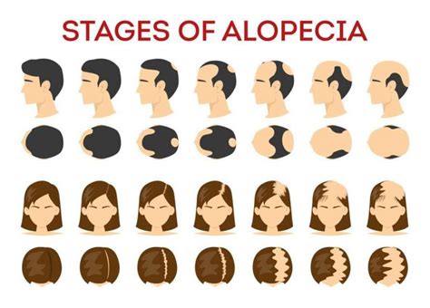 Stages of Alopecia - HealthGardeners