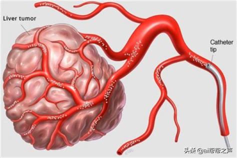 肝細胞癌經動脈化療栓塞治療（tace）詳解 每日頭條