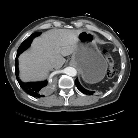 Pulmonary Sequestration Radiology Case Radiopaedia Org