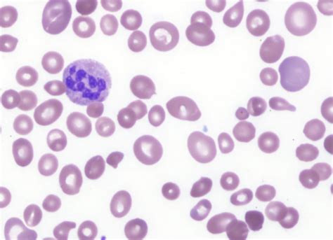 What is Anisocytosis - Definition, Causes and Treatment