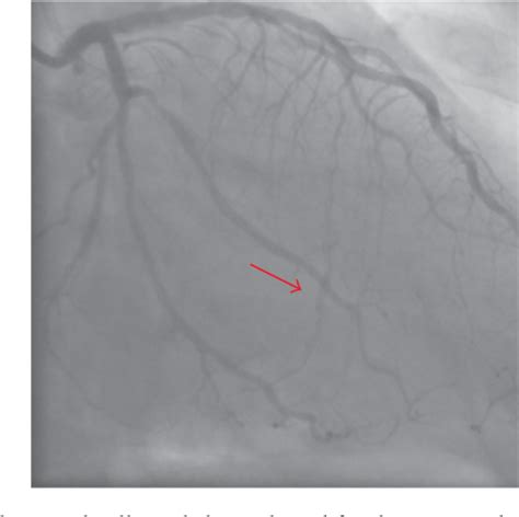 Figure From Interventricular Septal Hematoma After Retrograde