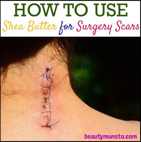 Shea Butter And Scars It Really Works Beautymunsta Free Natural