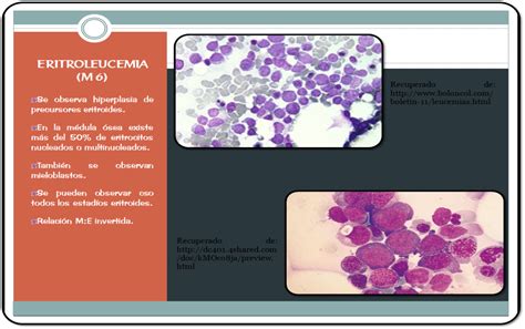 Procedimento M Dico Para Leucemia Mieloide Aguda