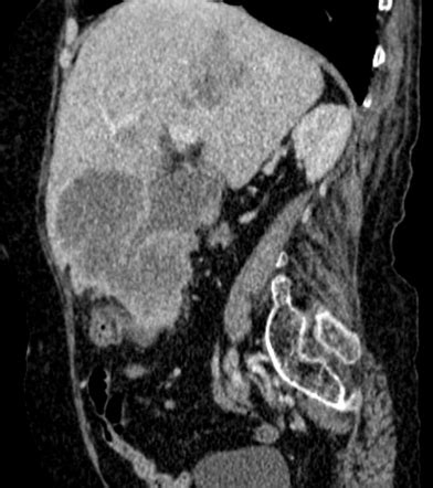 Gallbladder Carcinoma Radiology Case Radiopaedia Org