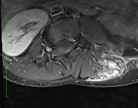 Plexiform Neurofibroma Image Radiopaedia Org