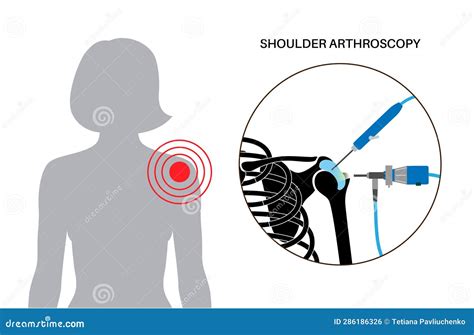 Shoulder Arthroscopy Poster Stock Vector Illustration Of Laparoscopy Inflamed 286186326